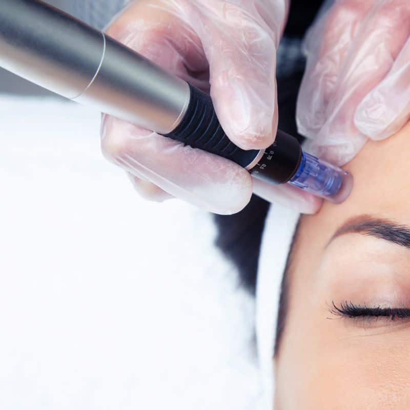 Morpheus8 treatment Waltham Abbey from Lipo Sculpt - Book in today!