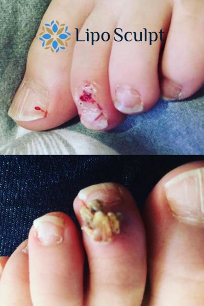 Wart removal customer results from Lipo Sculpt Waltham Abbey